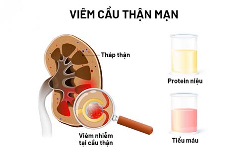 Viem cau than man la gi