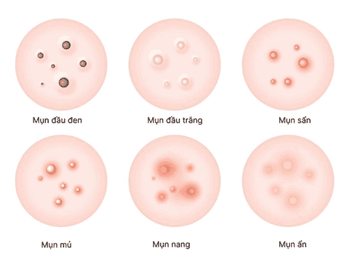 Các-loại-mụn-phân-biệt,-nguyên-nhân-và-cách-chăm-sóc-cho-từng-loại-mụn